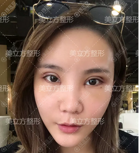 双眼皮自体脂肪填充术后7天自拍 双眼皮自体脂肪填充术后7天自拍