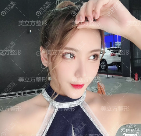 上海美立方闫磊做的双眼皮案例一个月效果 上海美立方闫磊做的双眼皮案例一个月效果