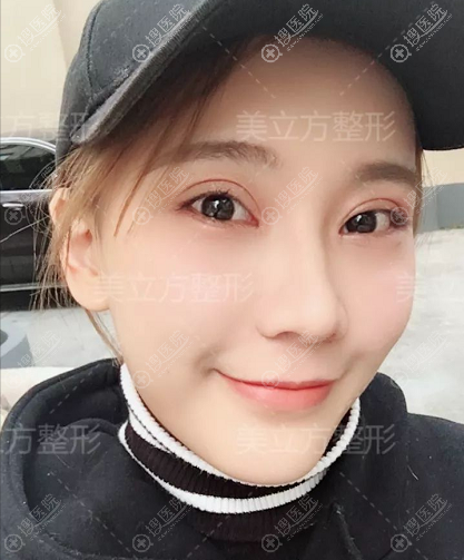 上海美立方闫磊医生做的双眼皮案例 上海美立方闫磊医生做的双眼皮案例