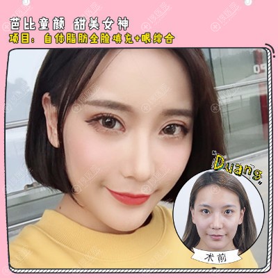 上海美立方闫磊医生的双眼皮脂肪填充案例对比图 上海美立方闫磊医生的双眼皮脂肪填充案例对比图