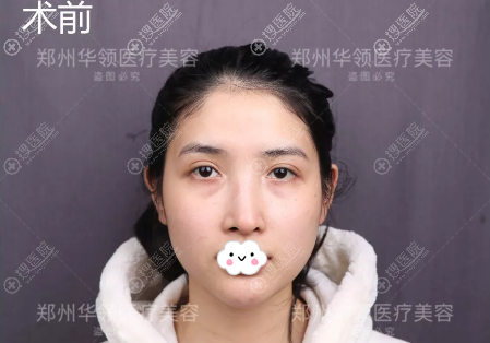 郑州华领整形全面部自体脂肪填充居然让我的大饼脸小了一圈