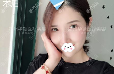 自体脂肪填充术后10天 自体脂肪填充术后10天