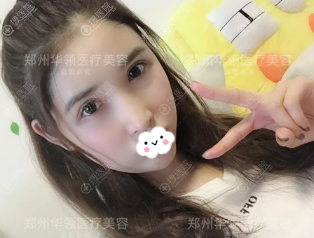郑州华领整形全面部脂肪填充效果 郑州华领整形全面部脂肪填充效果