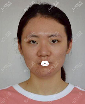 花1W价格找扬州施尔美厉建华割双眼皮+耳软骨复合隆鼻综合整形