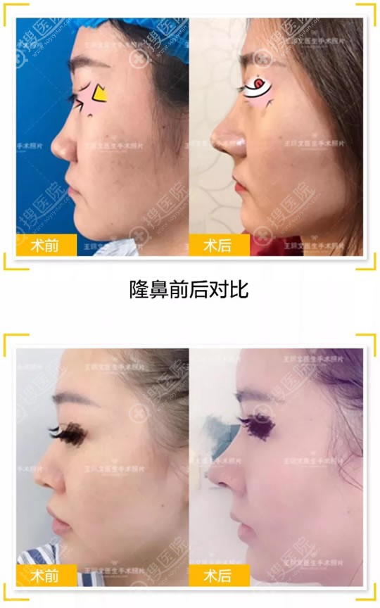 赣州华美王锦文隆鼻案例 赣州华美王锦文隆鼻案例