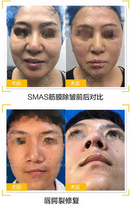赣州华美王锦文筋膜除皱和唇腭裂修复案例 赣州华美王锦文筋膜除皱和唇腭裂修复案例