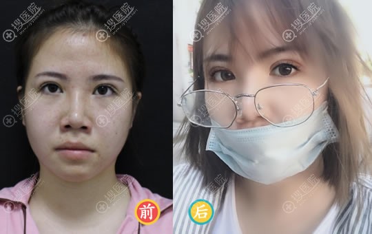 赣州华美王春院长双眼皮修复案例 赣州华美王春院长双眼皮修复案例