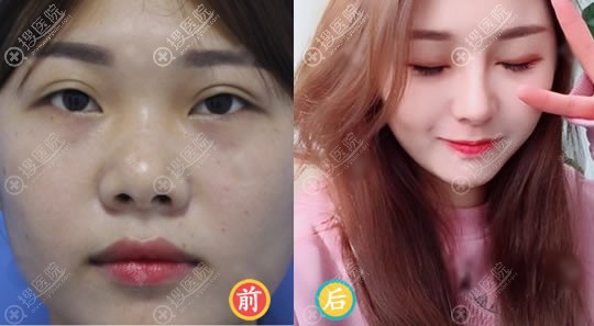 赣州华美晏传涛鼻修复案例 赣州华美晏传涛鼻修复案例