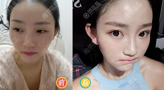 赣州华美牛先翠脂肪修复手术案例 赣州华美牛先翠脂肪修复手术案例
