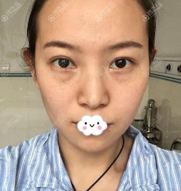 兰州时光激光整形美容医院罗梅内切去眼袋术后1-7天恢复图