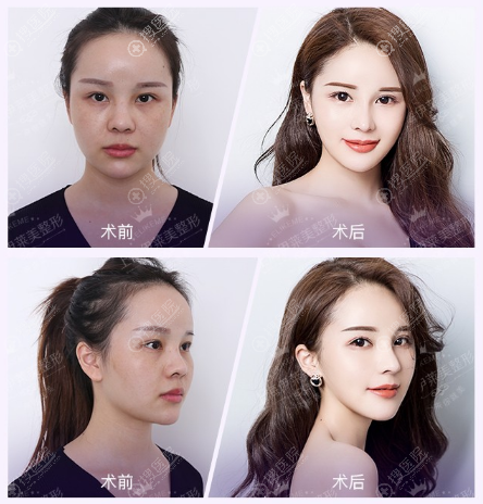 上海伊莱美<!--<i data=20240710 data-id=16406></i>-->做的肋骨鼻案例 上海伊莱美<!--<i data=20240710 data-id=16406></i>-->做的肋骨鼻案例