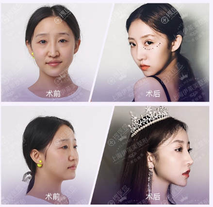 上海伊莱美<!--<i data=20240710 data-id=16406></i>-->全肋软骨鼻综合隆鼻案例 上海伊莱美<!--<i data=20240710 data-id=16406></i>-->全肋软骨鼻综合隆鼻案例