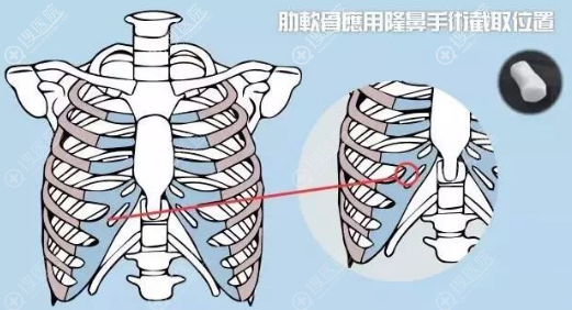 肋软骨应用隆鼻手术截取位置示意图 肋软骨应用隆鼻手术截取位置示意图