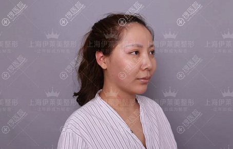 看了上海伊莱美江华的磨骨案例后找李湘原院长做了颧骨内推