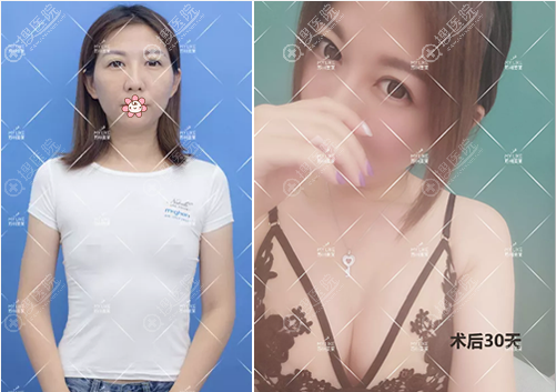 <!--<i data=20240710 data-id=13583></i>-->吴静假体隆胸术后对比 <!--<i data=20240710 data-id=13583></i>-->吴静假体隆胸术后对比