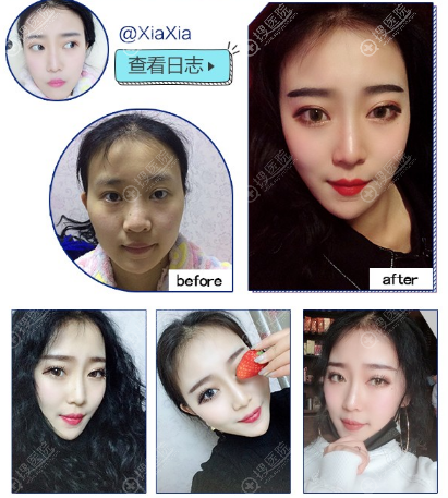 重庆当代王旭明做的肋软骨隆鼻案例图片 重庆当代王旭明做的肋软骨隆鼻案例图片