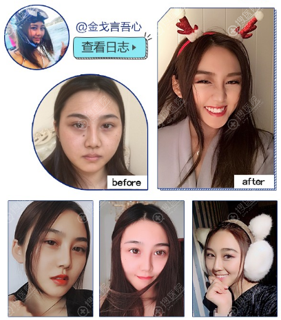 重庆当代王旭明鼻综合隆鼻案例图片 重庆当代王旭明鼻综合隆鼻案例图片