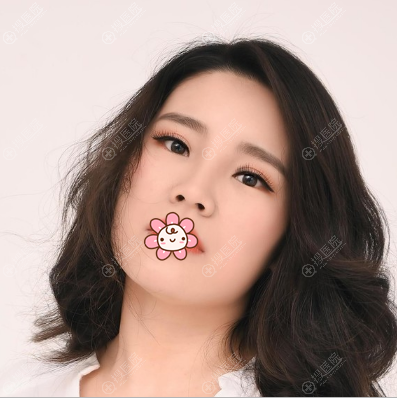 石家庄美莱高兴柳玻尿酸丰太阳穴案例 石家庄美莱高兴柳玻尿酸丰太阳穴案例