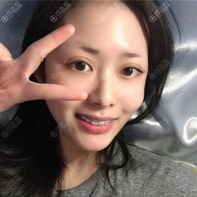 嘉兴艺星双眼皮案例术后7天 嘉兴艺星双眼皮案例术后7天