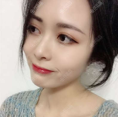 嘉兴艺星冯小良做的双眼皮好自然 嘉兴艺星冯小良做的双眼皮好自然