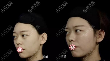 玻尿酸丰脸颊侧脸对比照 玻尿酸丰脸颊侧脸对比照