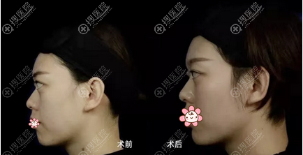 玻尿酸丰下巴术后即刻对比 玻尿酸丰下巴术后即刻对比