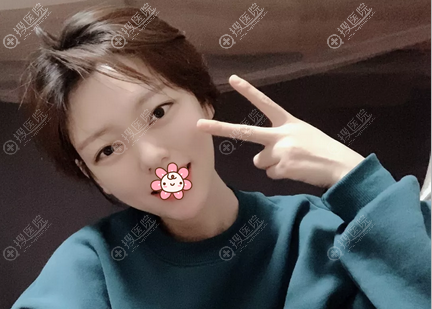 艾莉薇玻尿酸打下巴怎么样?术后7天效果 艾莉薇玻尿酸打下巴怎么样?术后7天效果