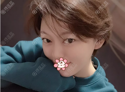 陈玉玻尿酸丰下巴术后7天 陈玉玻尿酸丰下巴术后7天