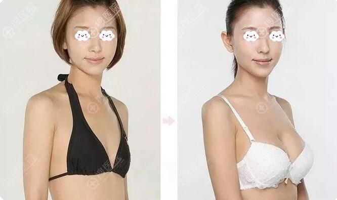 运城丽都整形医院王新灿内窥镜假体隆胸真人案例 运城丽都整形医院王新灿内窥镜假体隆胸真人案例