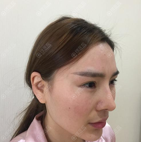 室友看我花29800元在苏州美莱医院磨下颌角效果这么好,她也要做