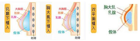 丰胸假体植入方式 丰胸假体植入方式