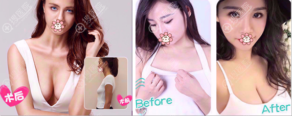 深圳美莱假体丰胸术后效果 深圳美莱假体丰胸术后效果