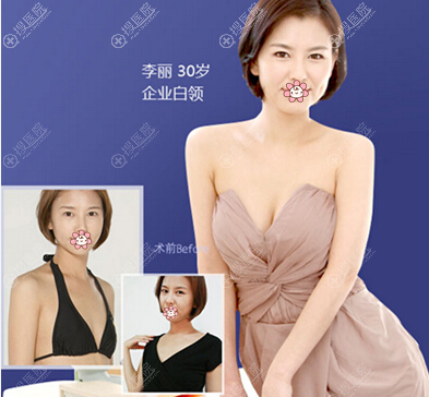 深圳美莱徐英丰胸案例效果展示 深圳美莱徐英丰胸案例效果展示