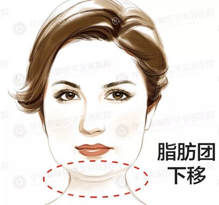 看了这组自体脂肪填充失败案例图片你还敢随便找医院做填充吗?