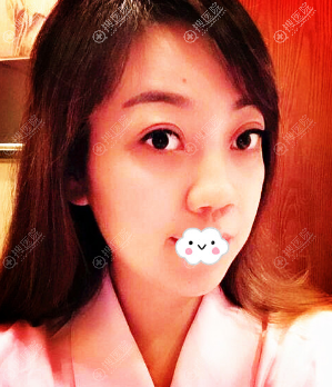 四川成都西婵胡山自体肋软骨隆鼻真人案例 四川成都西婵胡山自体肋软骨隆鼻真人案例