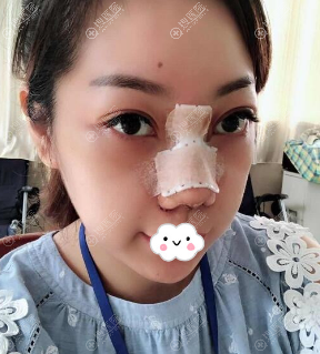 四川成都西婵胡山肋软骨隆鼻术后5天照片 四川成都西婵胡山肋软骨隆鼻术后5天照片