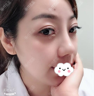 成都西婵胡山肋软骨隆鼻术后17天恢复图 成都西婵胡山肋软骨隆鼻术后17天恢复图