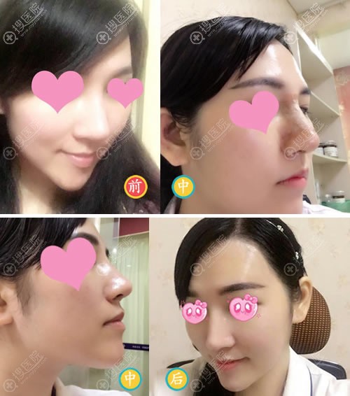 <!--<i data=20240710 data-id=8266></i>-->整形朱峻宏隆鼻案例 <!--<i data=20240710 data-id=8266></i>-->整形朱峻宏隆鼻案例