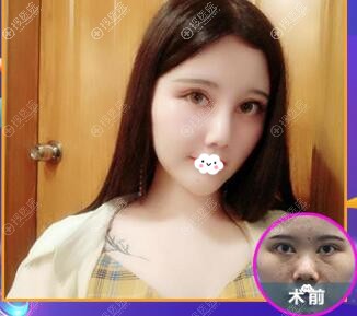 福州比利华鼻综合隆鼻真人案例 福州比利华鼻综合隆鼻真人案例