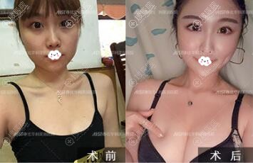 福州比利华刘耀美自体脂肪隆胸案例效果图 福州比利华刘耀美自体脂肪隆胸案例效果图