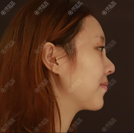 去福州海峡和台江看了看,还是喜欢爱美尔张胜利院长的隆鼻风格