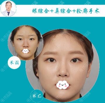 <!--<i data=20240710 data-id=17362></i>--><!--<i data=20240710 data-id=17361></i>-->双眼皮+隆鼻+面部轮廓整形案例 <!--<i data=20240710 data-id=17362></i>--><!--<i data=20240710 data-id=17361></i>-->双眼皮+隆鼻+面部轮廓整形案例