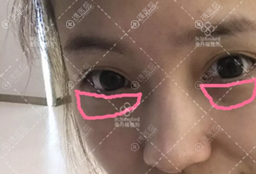 术前眼袋特写照片 术前眼袋特写照片