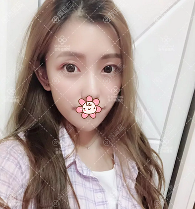 <!--<i data=20240710 data-id=12057></i>-->林靖割眼袋效果 <!--<i data=20240710 data-id=12057></i>-->林靖割眼袋效果