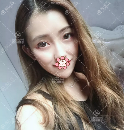 <!--<i data=20240710 data-id=12057></i>-->内路眶隔释放术后照片 <!--<i data=20240710 data-id=12057></i>-->内路眶隔释放术后照片