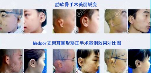 <!--<i data=20240710 data-id=17362></i>-->孟庆璋耳畸形再造真人案例 <!--<i data=20240710 data-id=17362></i>-->孟庆璋耳畸形再造真人案例