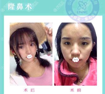 <!--<i data=20240710 data-id=17362></i>-->鼻综合隆鼻案例 <!--<i data=20240710 data-id=17362></i>-->鼻综合隆鼻案例
