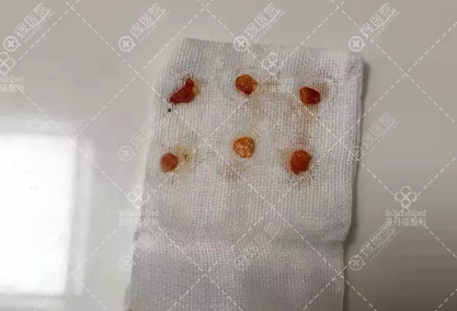 割眼袋手术中取出的多余脂肪 割眼袋手术中取出的多余脂肪