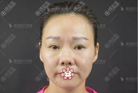 从广场舞大妈到贵妇她只是在深圳雅涵做了综合隆鼻面部脂肪填充