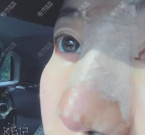 埃菲尔综合隆鼻术后即刻 埃菲尔综合隆鼻术后即刻